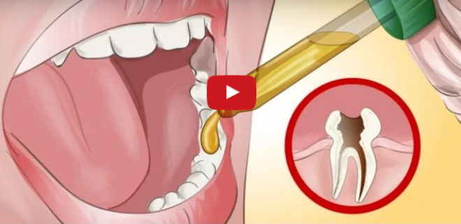 Fogfájás elleni hatékony házi módszer, ha nincs fogorvos a közelben