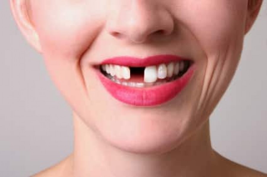 12 rossz szokás, amellyel kárt okozhatsz a fogaidban!